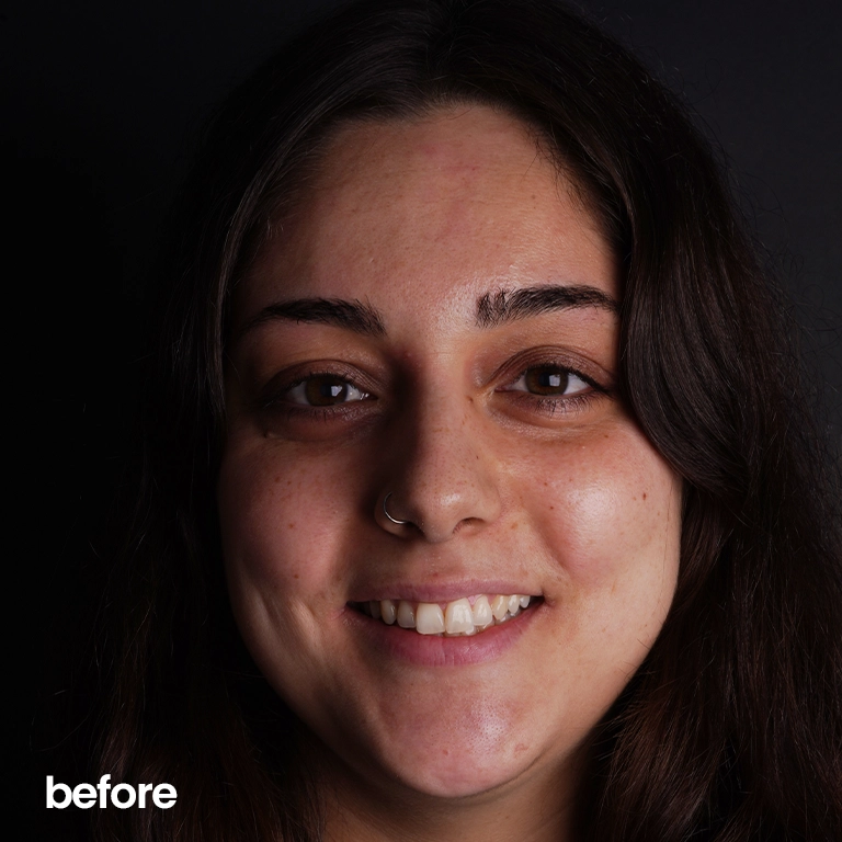 Hollywood Smile vs. Veneers What’s the Difference