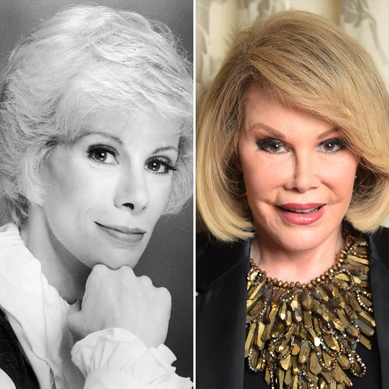 Joan Rivers Before and After