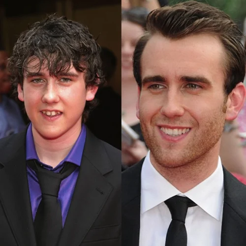 Matthew Lewis’ Dental Aesthetic Transformation