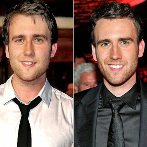 Matthew Lewis’ Orthodontic Treatment Journey
