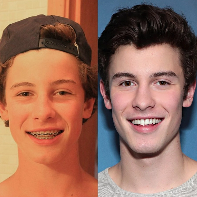 Shawn Mendes Before and After A Subtle Transformation