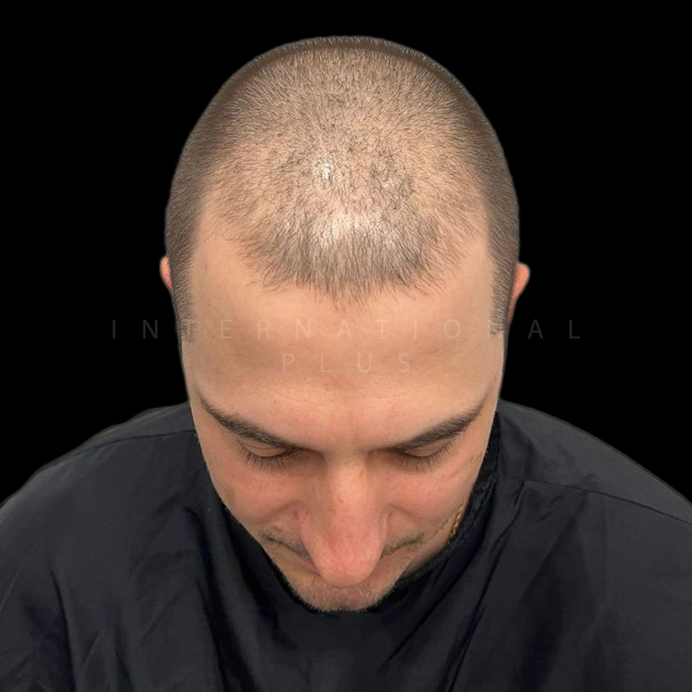 hair-transplant-before-after-17 hair transplant before after 17