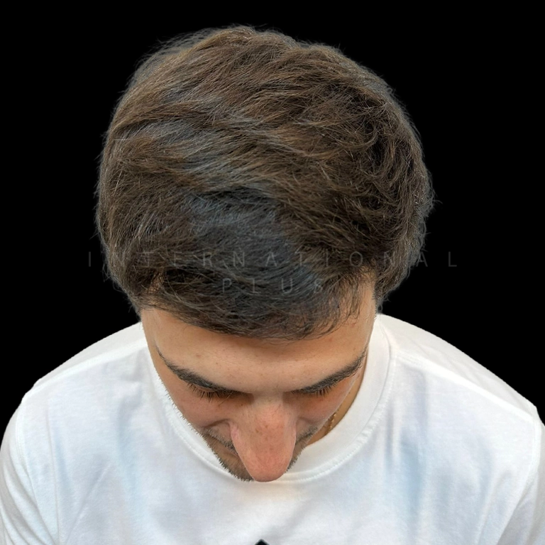 hair-transplant-before-after-18 hair transplant before after 18