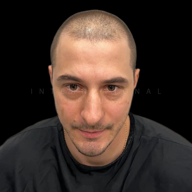 hair-transplant-before-after-19 hair transplant before after 19