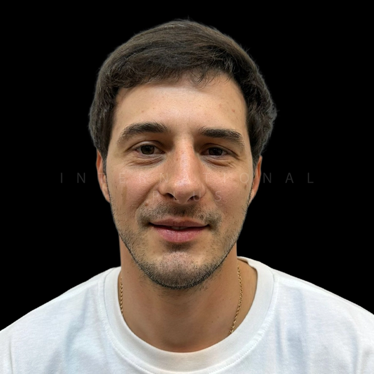 hair-transplant-before-after-20 hair transplant before after 20