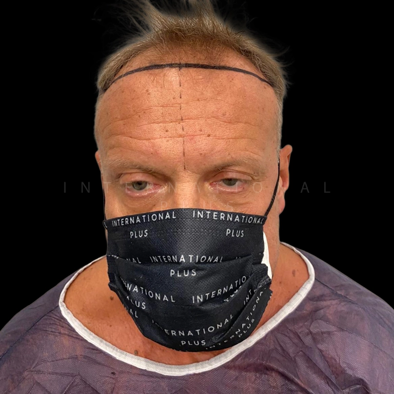 hair transplant before after 21