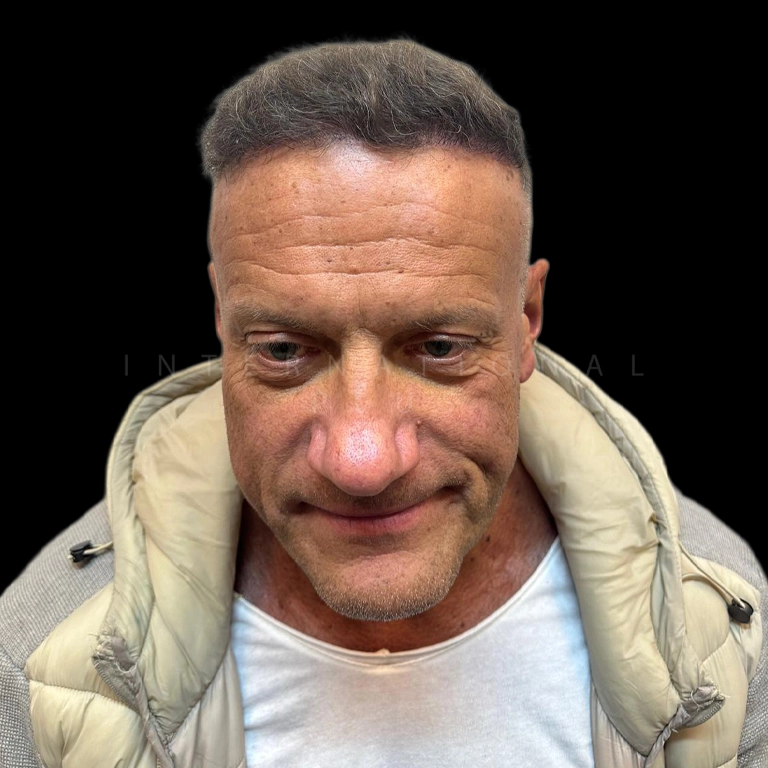 hair transplant before after 22
