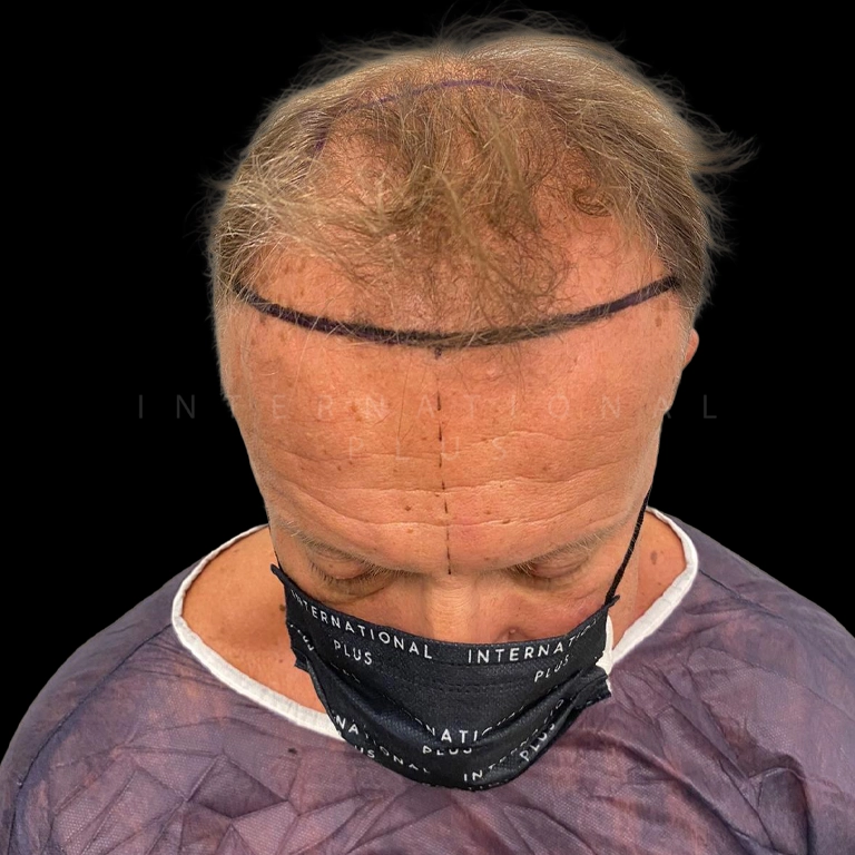 hair transplant before after 23