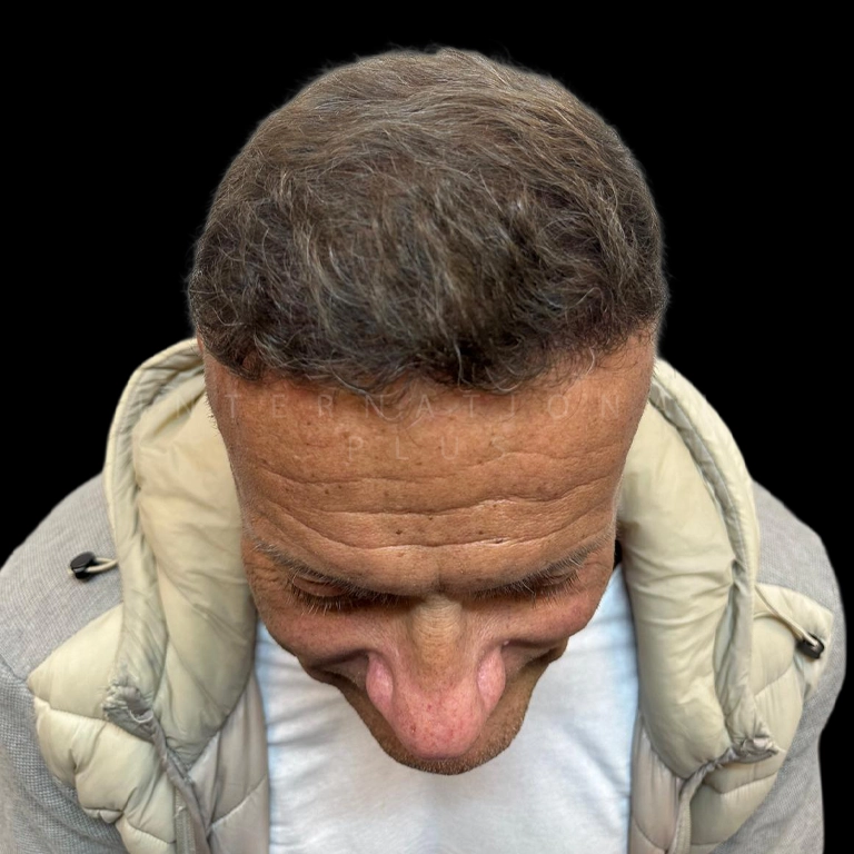 hair transplant before after 24