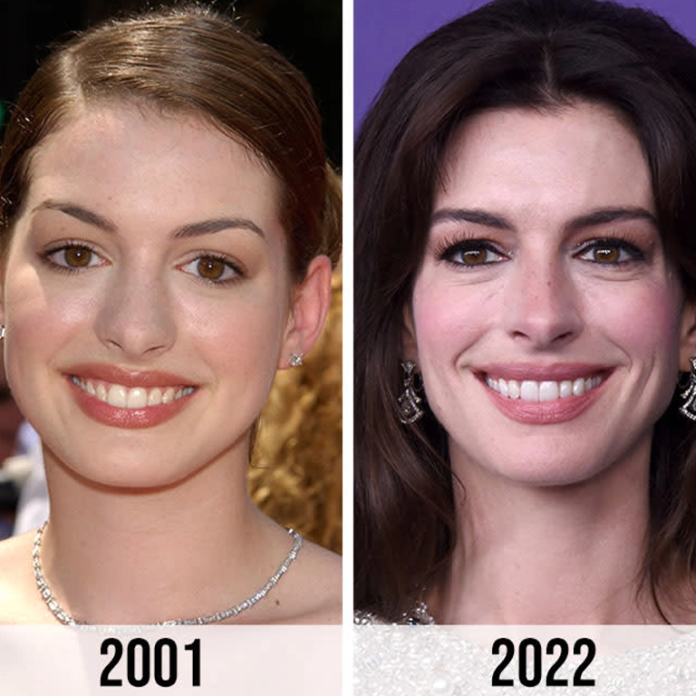 Anne Hathaway Plastic Surgery