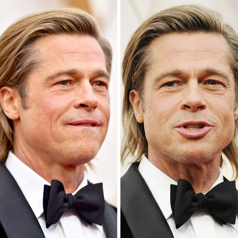 Brad Pitt Cheek Lift Procedure