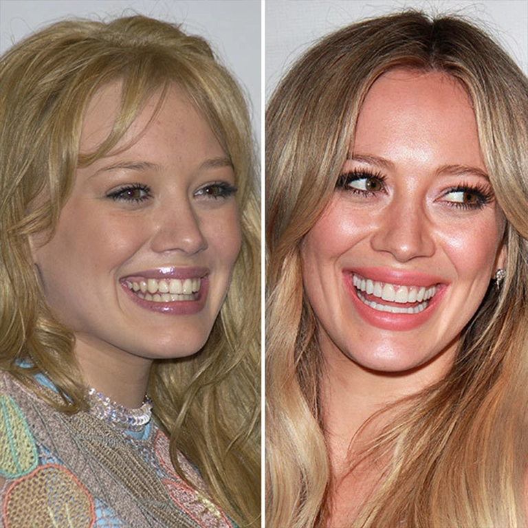 Hilary Duff Cosmetic Dentistry