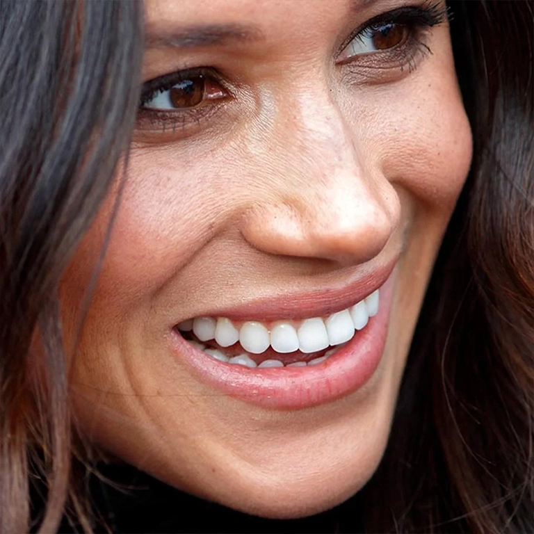 Meghan Markle Dental Aesthetics