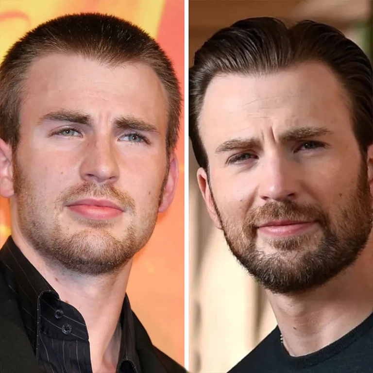 Chris Evans Hair Loss Treatment