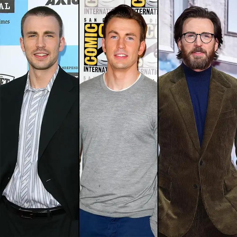 Chris Evans Hair Restoration Journey
