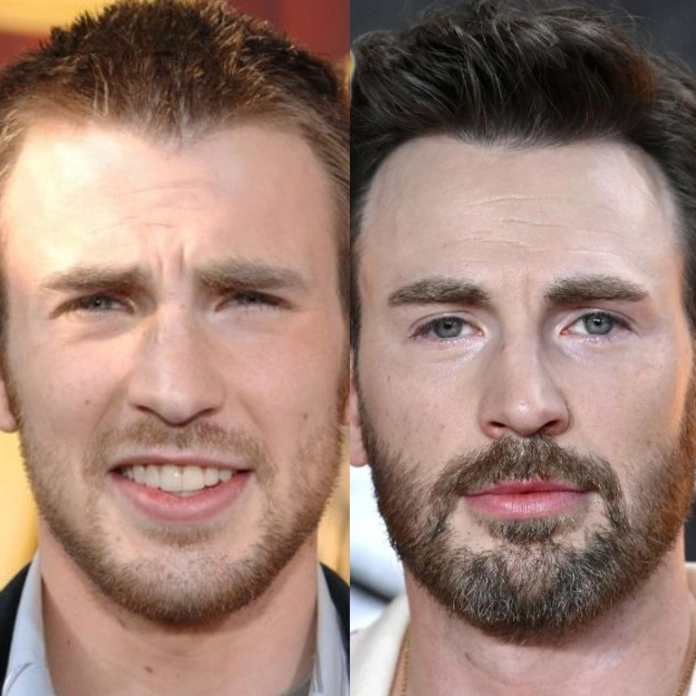 Chris Evans Scalp Micropigmentation