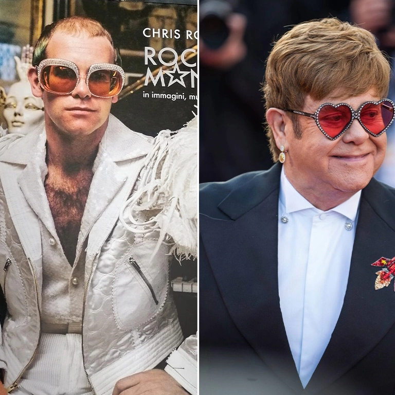 Elton John Before and After Hair Transplant