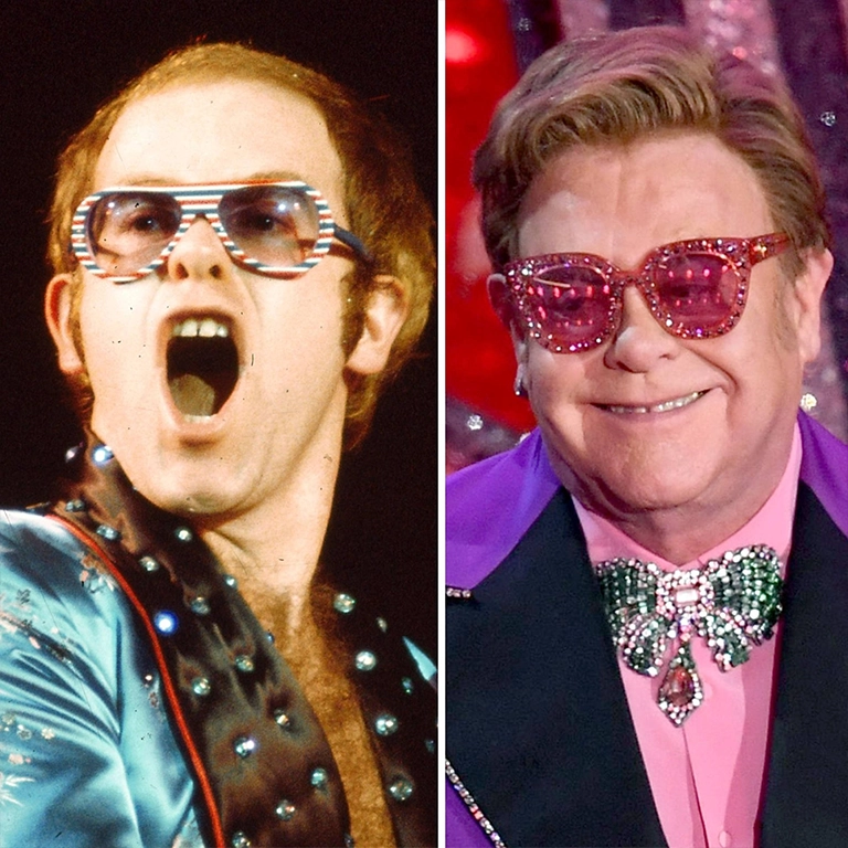 Elton John Hair Transplant Recovery