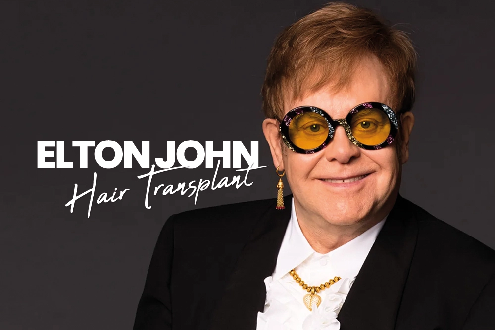 Elton John Hair Transplant