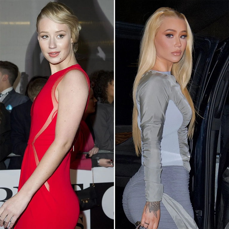 Iggy Azalea Boob Job