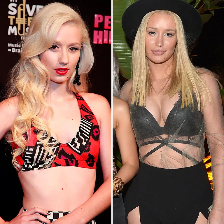 Iggy Azalea Lip Filler