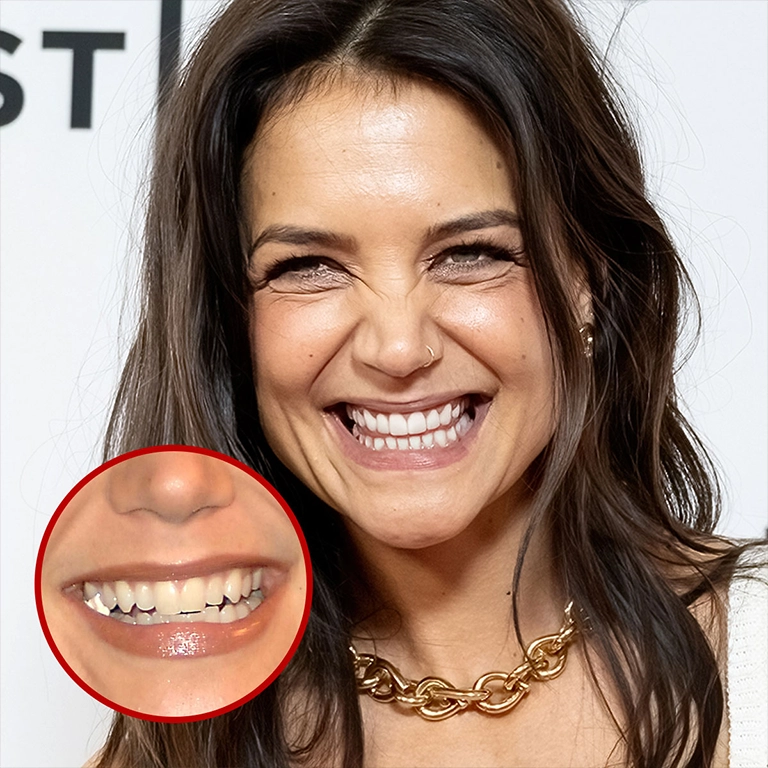 Katie Holmes Smile Before and After