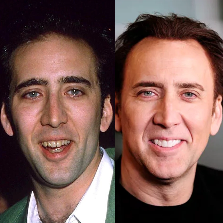 Nicolas Cage Before and After Veneers