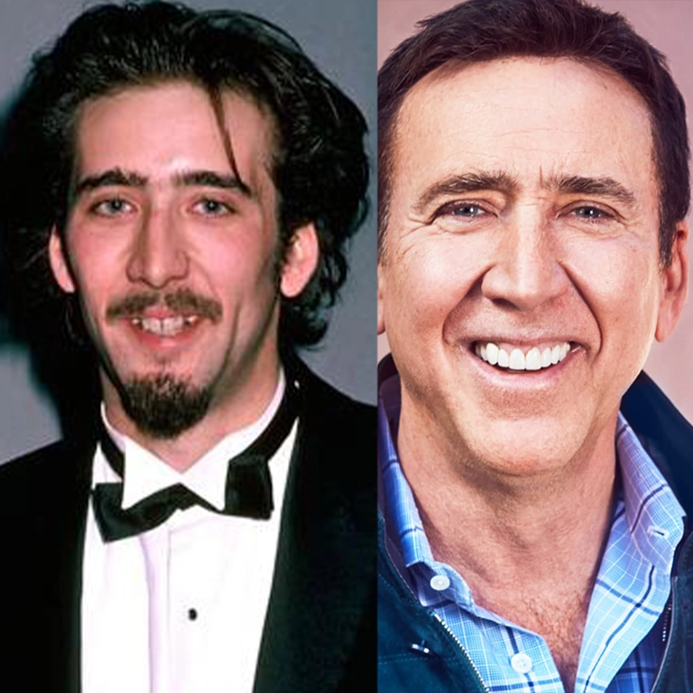 Nicolas Cage Smile Before and After