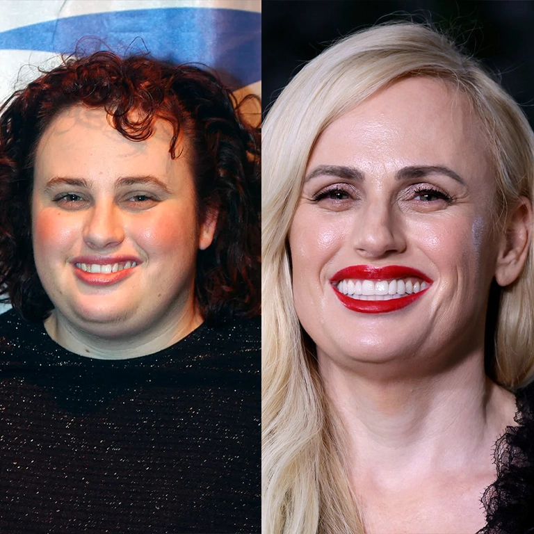 Rebel Wilson Before and After Veneers