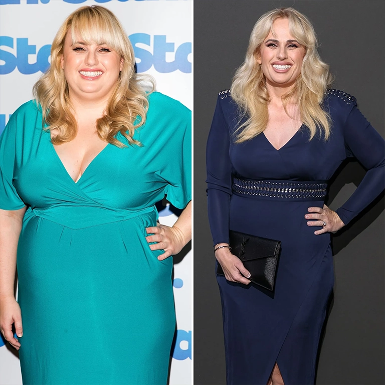 Rebel Wilson Smile Makeover Journey