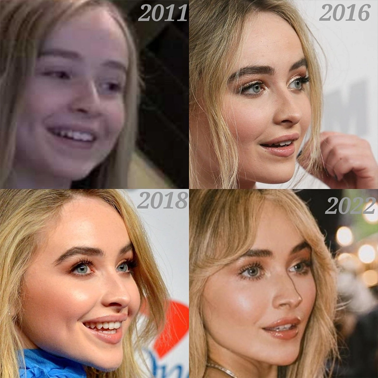 Sabrina Carpenter Lip Filler
