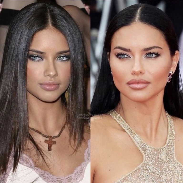 Adriana Lima Before and After Surgery