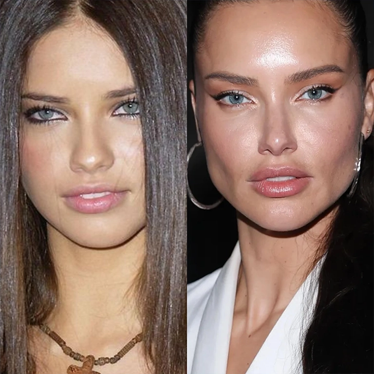 Adriana Lima Lip Filler Speculation