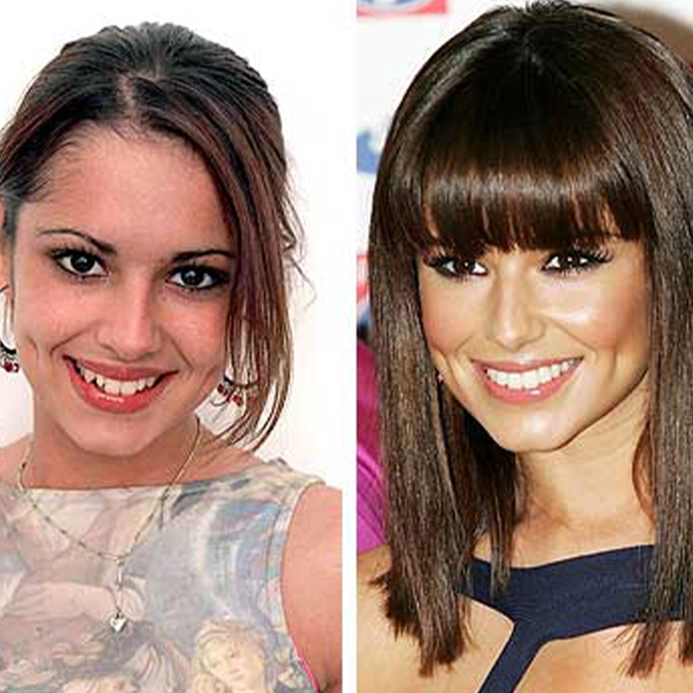 Cheryl Cole Dental Aesthetics