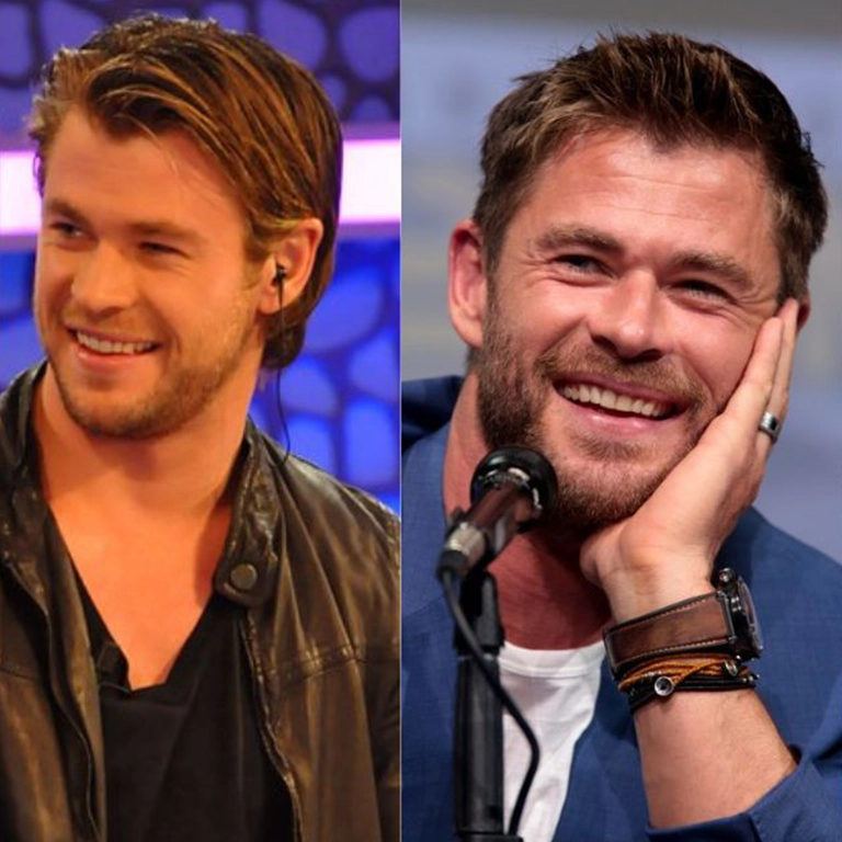 Chris Hemsworth Hair Restoration Journey