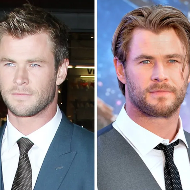 Chris Hemsworth Hairline Correction