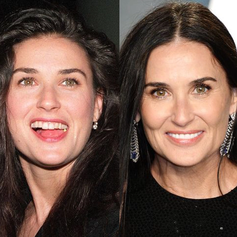 Demi Moore Teeth Transformation