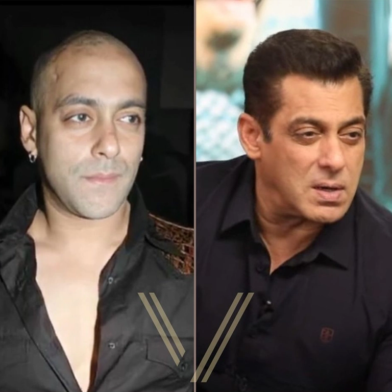 Did Salman Khan Get a Hair Transplant