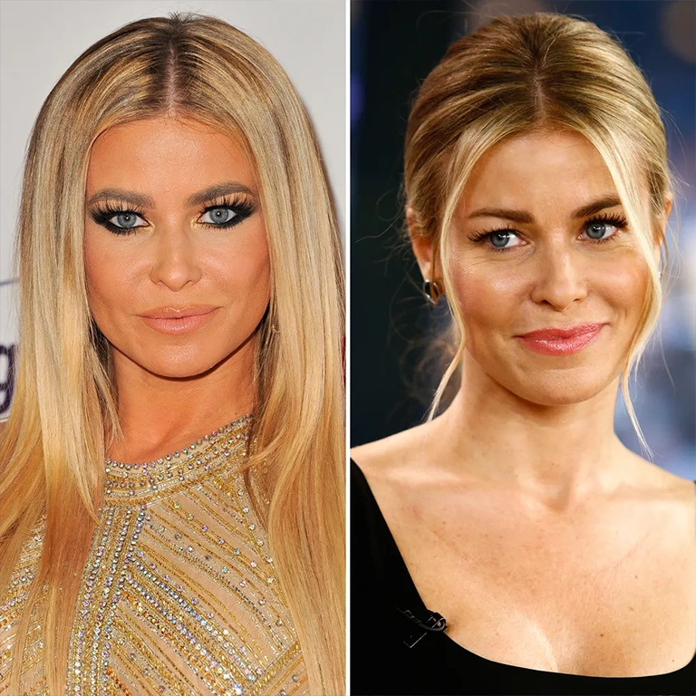 Facial Fillers and Botox for Anti Aging