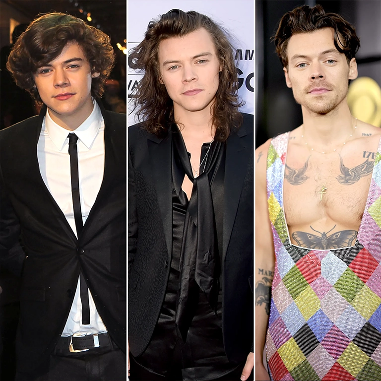 Harry Styles FUE Hair Transplant