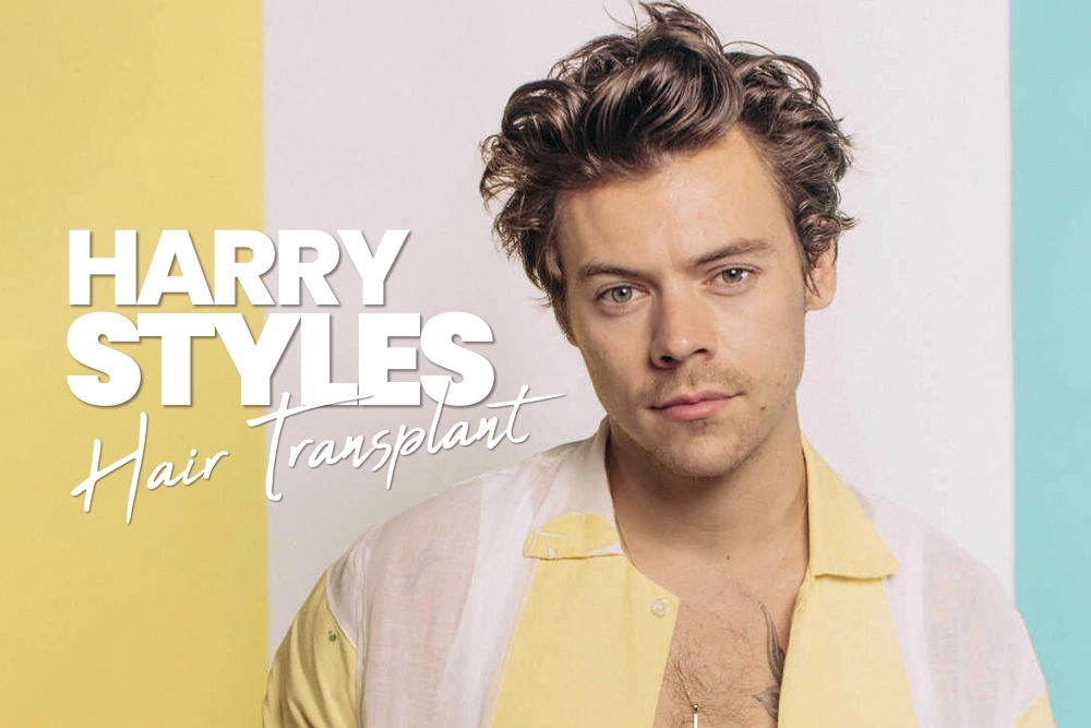 Harry Styles Hair Transplant