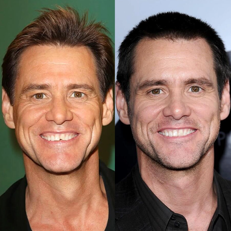 Jim Carrey Tooth Correction