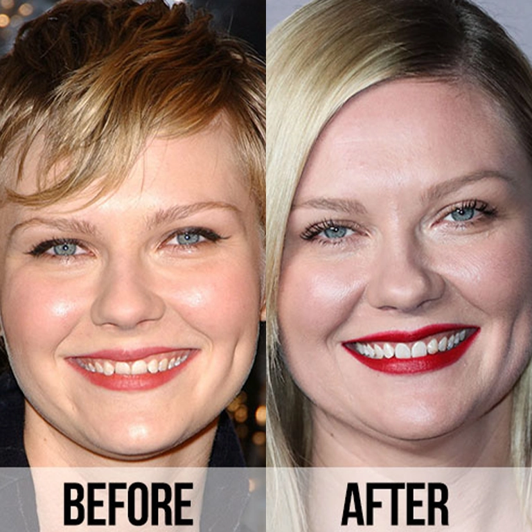 Kirsten Dunst Cosmetic Dentistry