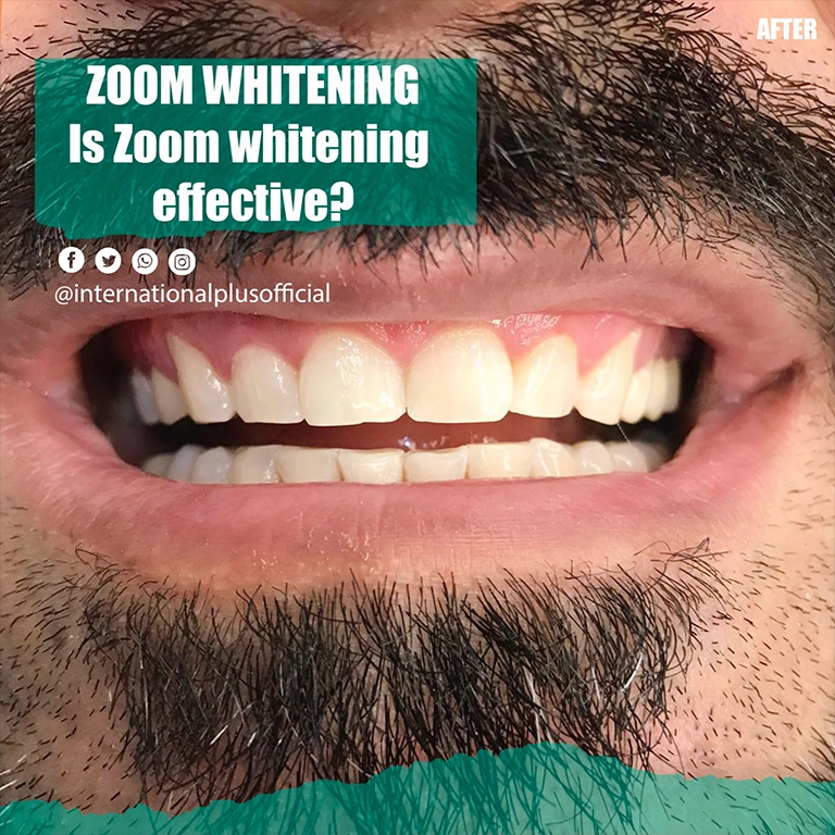 Professional Teeth Whitening vs Home Kits