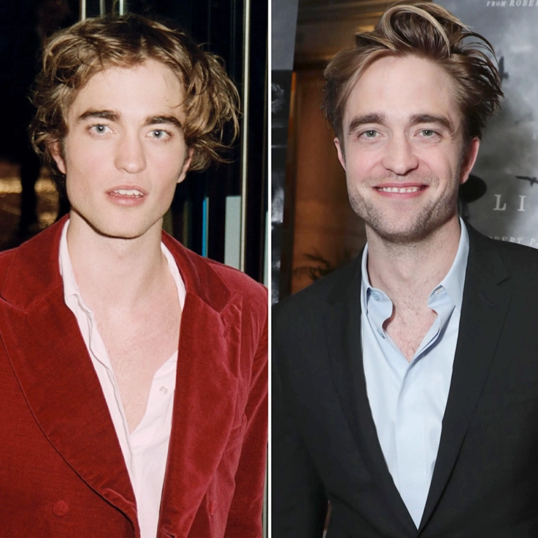 Robert Pattinson Jawline Surgery