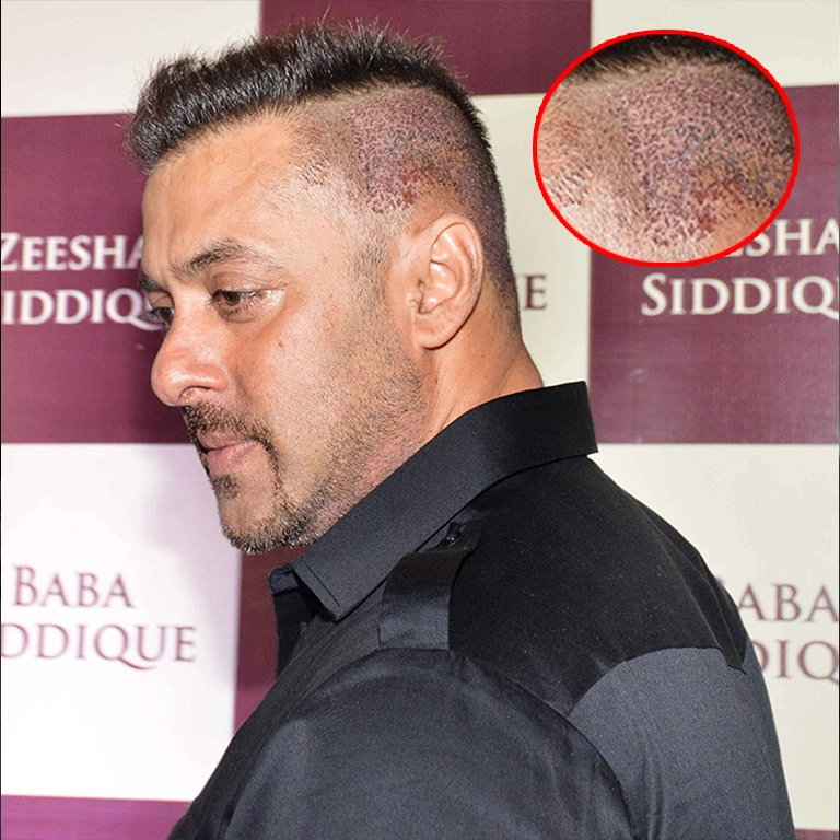 Salman Khan FUE Hair Transplant