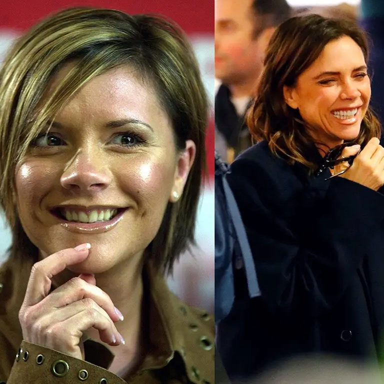 Victoria Beckham Teeth Transformation