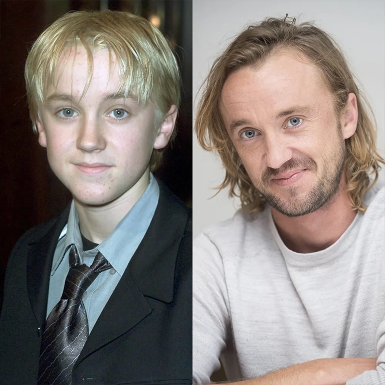did tom felton get plastic surgery
