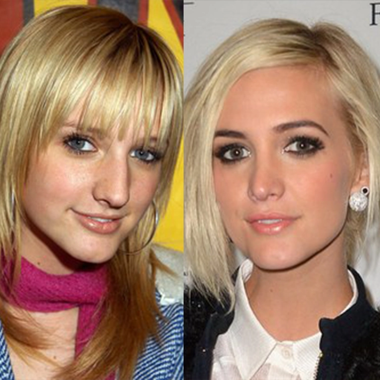 Ashlee Simpson Rhinoplasty Before and After
