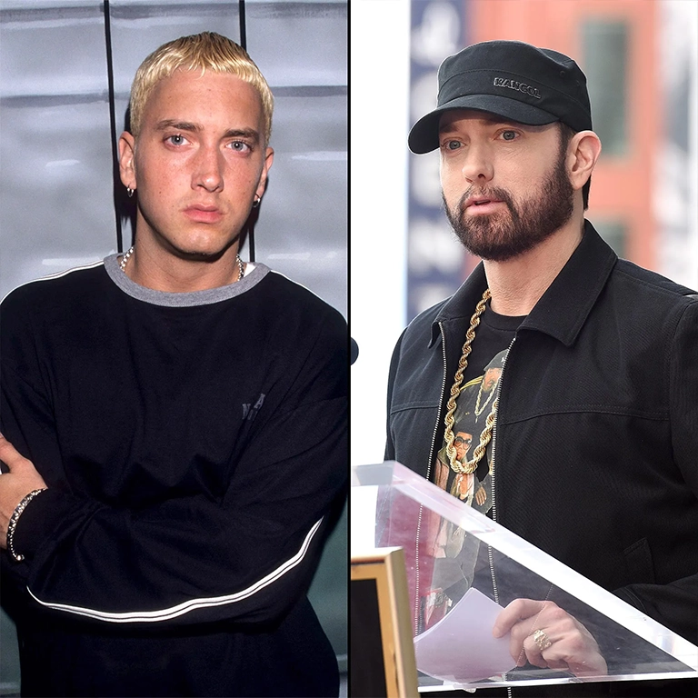Did Eminem Have Botox or Fillers